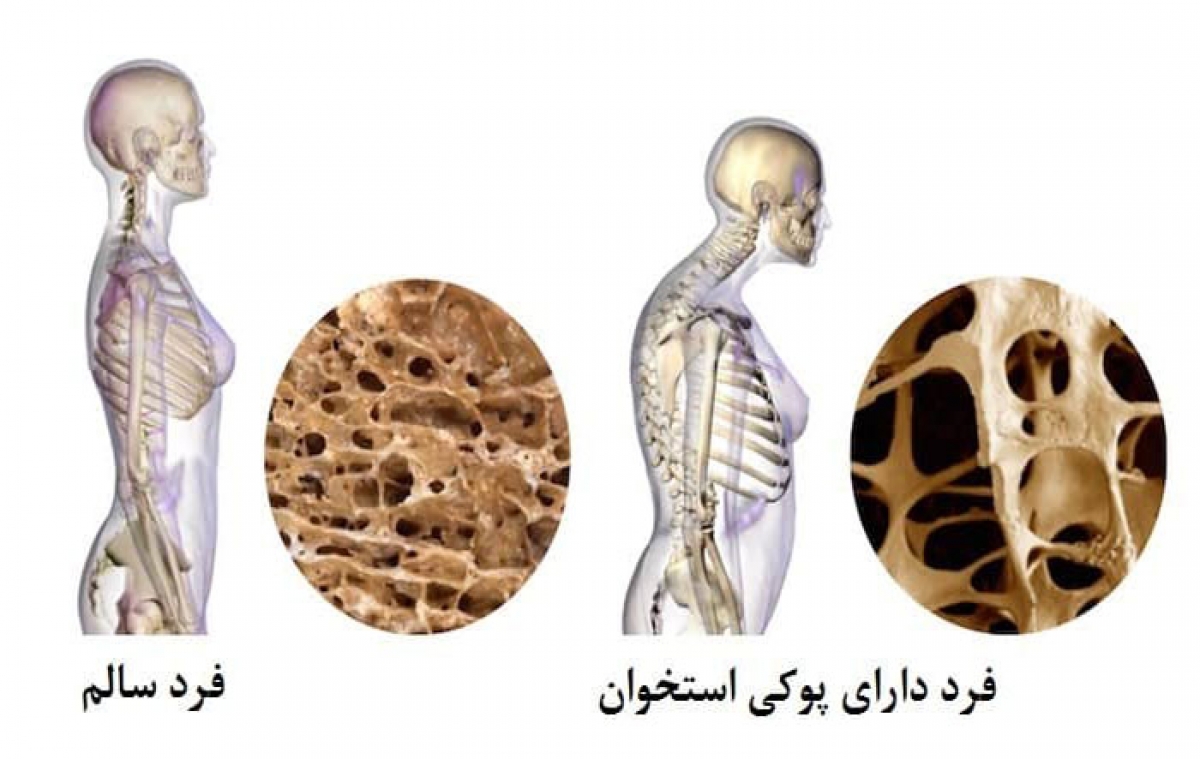 نشانه پوکی استخوان چیست؟