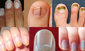 تغییر رنگ ناخن‌ها نشانه چیست؟